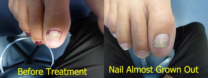 laser-treatment-for-toenail-fungus-4