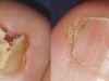 laser-treatment-for-toenail-fungus-5