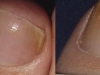laser-treatment-for-toenail-fungus-6