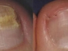 laser-treatment-for-toenail-fungus-7