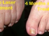 laser-treatment-for-toenail-fungus