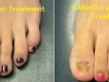 laser-treatment-for-toenail-fungus_0