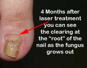 Nail Fungus treatment