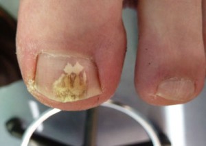 Toenail Fungus