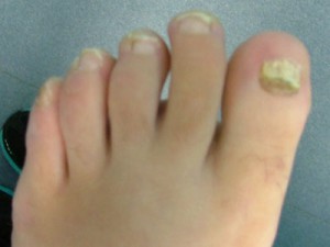 Toe nail Fungal infection