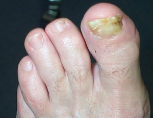 Fungus of a Toe Nail